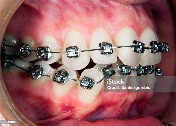 Photo libre de droit de Soin Orthodontic Gingival Recesion banque d'images et plus d'images libres de droit de Appareil dentaire - Appareil dentaire, Dentisterie esthétique, Dentition humaine