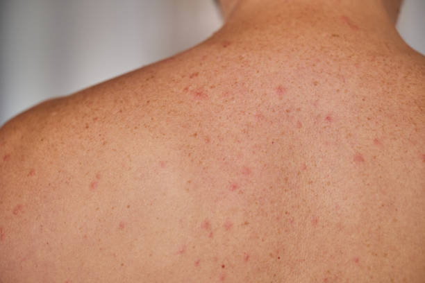 istock Man's back with acne, red spots, skin disease 1554105498