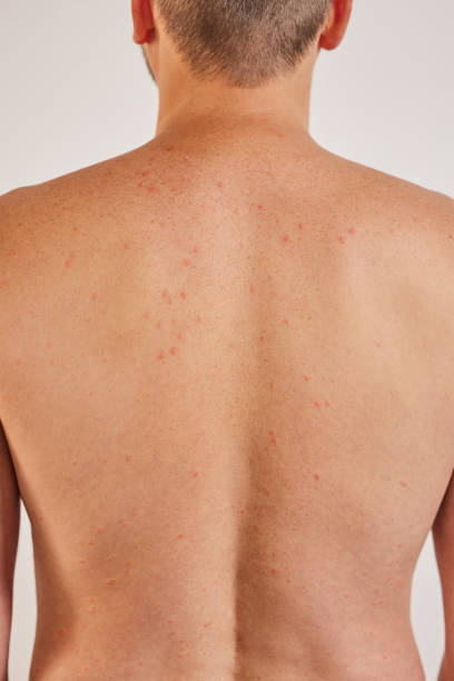 istock Man's back with acne, red spots, skin disease 1554112925