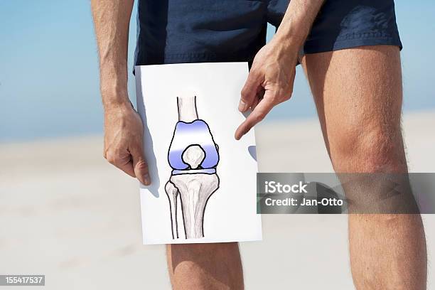 Insgesamt Knie Erneuerung Stockfoto und mehr Bilder von Künstliches Kniegelenk - Künstliches Kniegelenk, Knie, Prothese