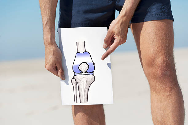 Total knee replacement Drawing of a total knee endoprosthesis (KEP). Please note: the patella doesn`t have to be replaced in most cases, that`s why there is an "original" patella in the drawing here. XXL size image. artificial knee photos stock pictures, royalty-free photos & images