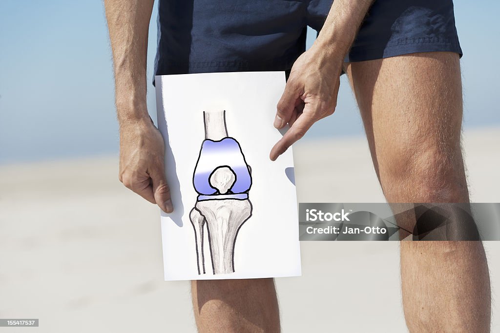 Тотальное протезирование коленного сустава - Стоковые фото Коленный протез роялти-фри