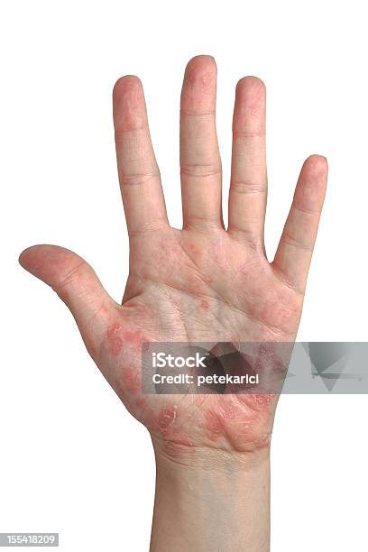 Psoríase Mão Aberta - Fotografias de stock e mais imagens de Psoríase - Psoríase, Dermatite, Irritação