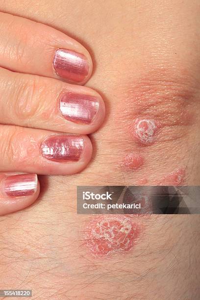 Psoriasis Foto de stock y más banco de imágenes de Adulto - Adulto, Afección médica, Articulación humana