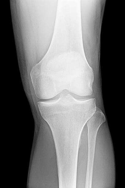 膝の部位の x 線骨人の脚 - lateral condyle ストックフォトと画像