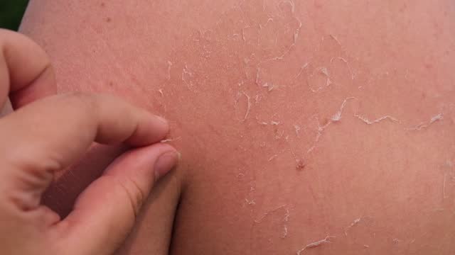 The man received sunburn on seashore. The skin peels off. Protection of the skin from the sun.
