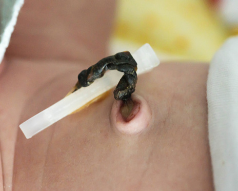 The remains of the umbilical cord in a baby after birth. Healing of the umbilical wound and umbilical ring, close-up. Sterile