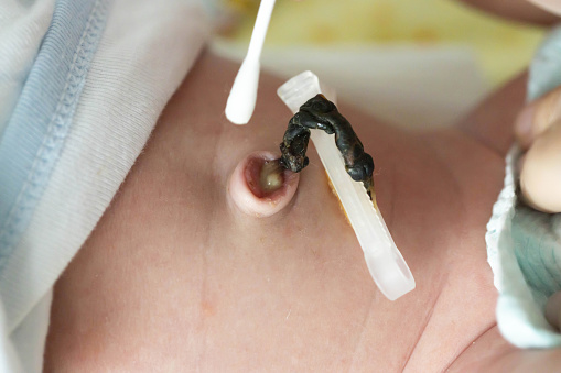 Treatment of the navel and umbilical cord of a newborn with hydrogen peroxide and a cotton swab to dry and heal the umbilical cord of an infant...