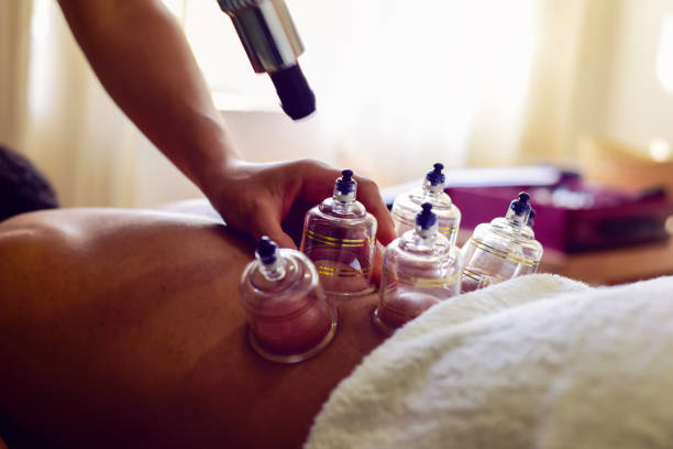 istock Multiple vacuum cups, medical cupping therapy on human body 1554803857