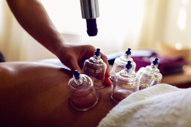 istock Multiple vacuum cups, medical cupping therapy on human body 1554803859