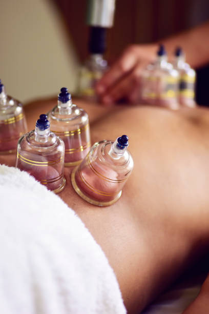 istock Multiple vacuum cups, medical cupping therapy on human body 1554804415