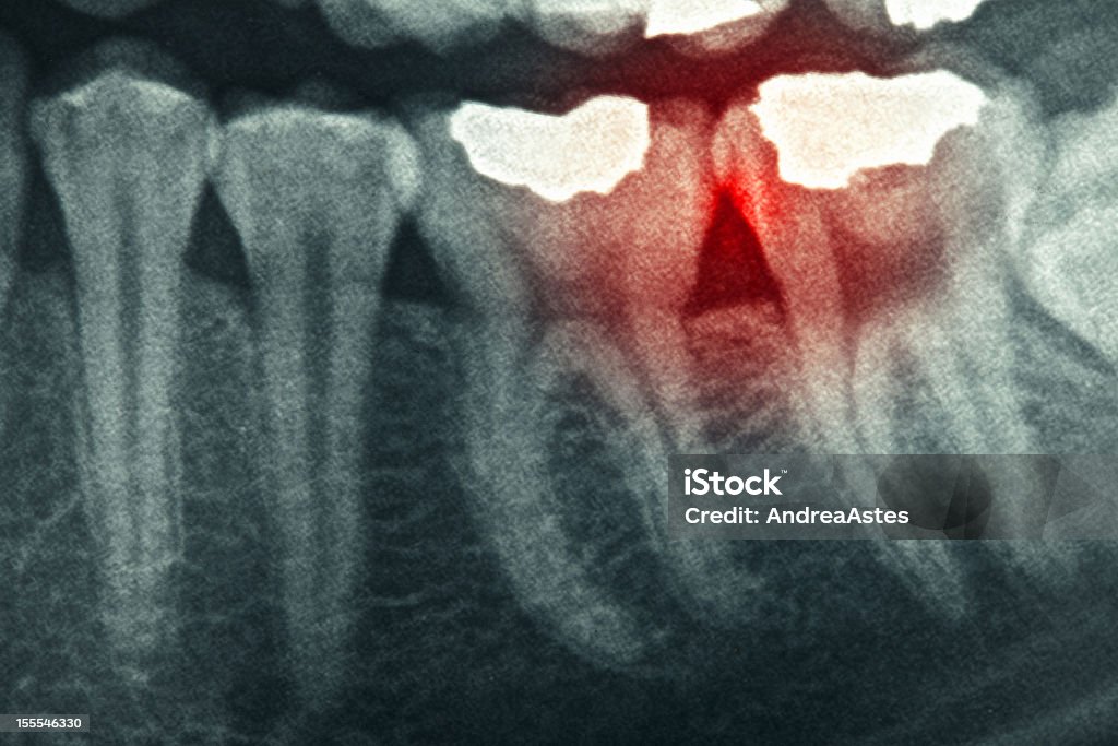 Dental xray - Lizenzfrei Anatomie Stock-Foto