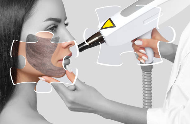 istock A woman with a carbon mask on her face, a beautician does laser carbon peeling on the problem areas of the skin of a young beautiful girl. Cosmetology and professional skin care. 1555472808