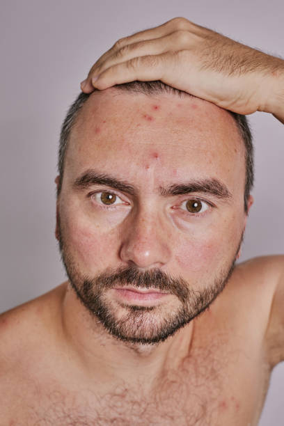 istock Man's forehead with acne, red spots, skin disease 1555653130