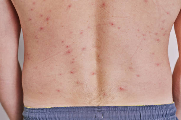 istock Man's back with acne, red spots, skin disease 1555653131
