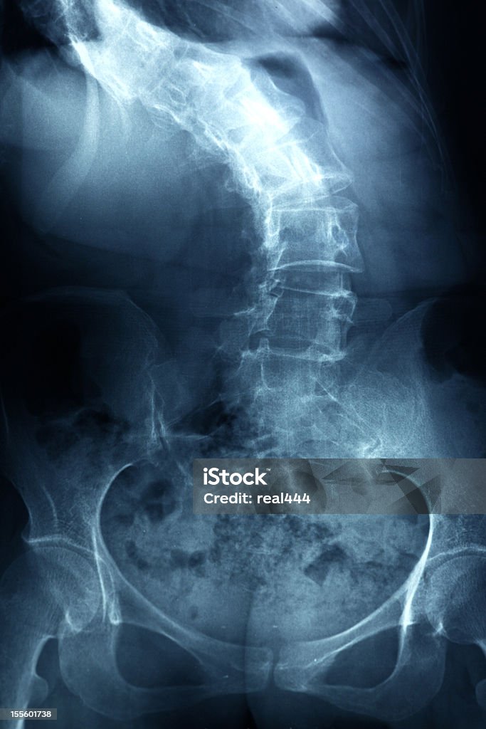 Imagen de rayos X columna vertebral humana - Foto de stock de Escoliosis libre de derechos