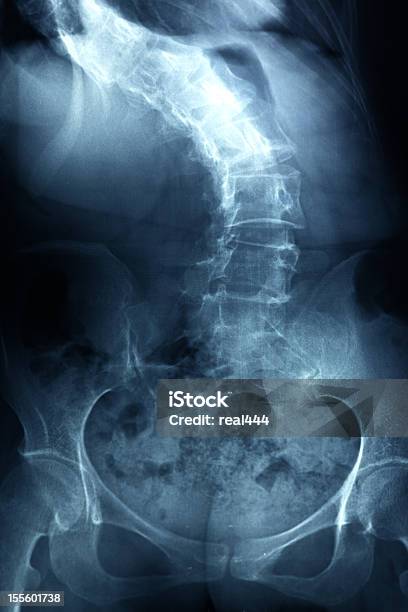 Imagen De Rayos X Columna Vertebral Humana Foto de stock y más banco de imágenes de Escoliosis - Escoliosis, Parálisis, Imagen de rayos X