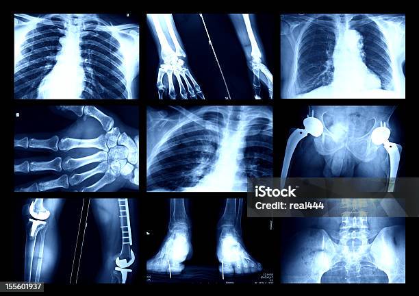 X레이 X-레이에 대한 스톡 사진 및 기타 이미지 - X-레이, 건강 진단, 건강관리와 의술