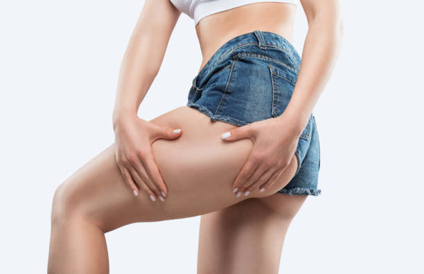 ein schlankes mädchen in kurzen jeansshorts dehnt die haut an ihrem bein und zeigt fettablagerungen. behandlung und beseitigung von übergewicht, ablagerung von unterhautfett. - torso female hip human skin stock-fotos und bilder