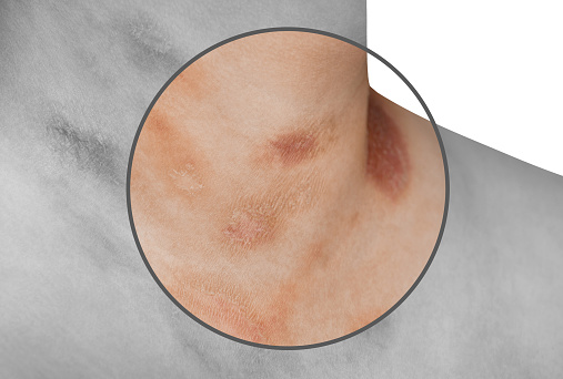 One person with Pityriasis rosea disease on the chest and neck on an isolated background