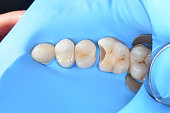 Artistic restoration and restoration of the contact point on the tooth 2.6. Close-up photo in dentist room
