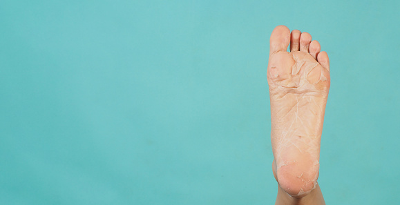 Left Foots peeling or remove dead skin on mint green background.