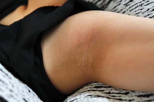 istock A woman's axillary hair a few days after shaving. 1557806071