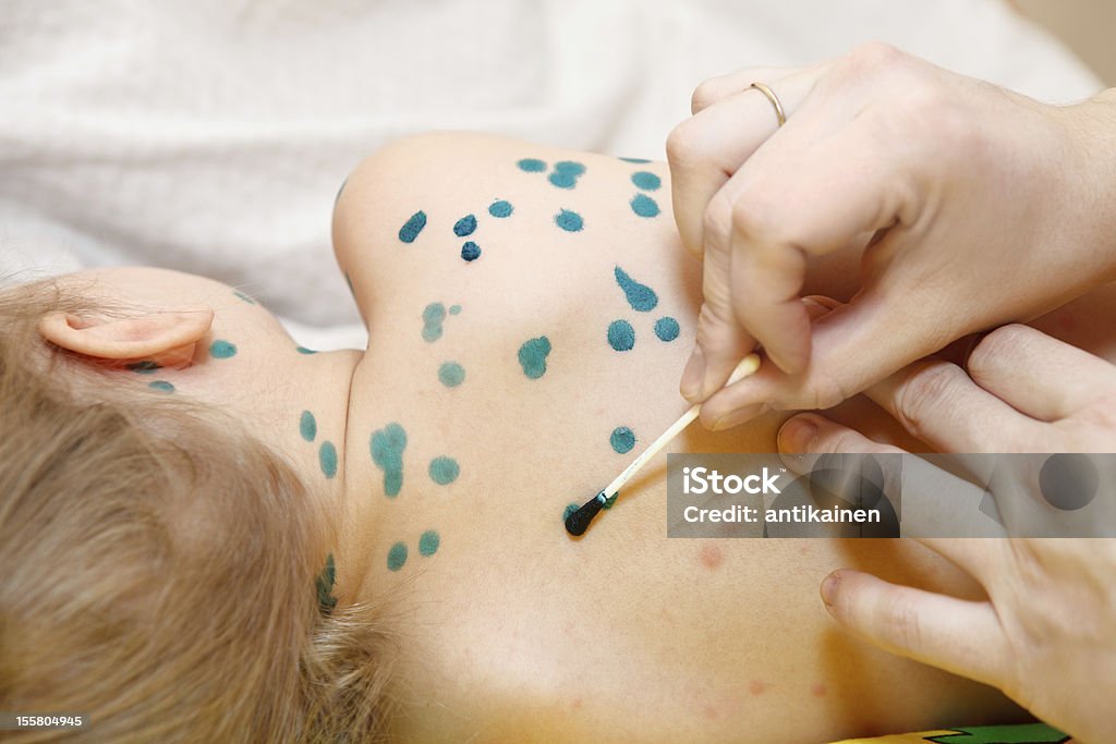 Little child with varicella zoster virus illness Little child with varicella zoster virus illness. Therapy of green paint or brilliant green dye. 2-3 Years Stock Photo