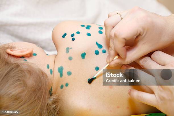 Little Child With Varicella Zoster Virus Illness Stock Photo - Download Image Now - 2-3 Years, Alternative Therapy, Chickenpox