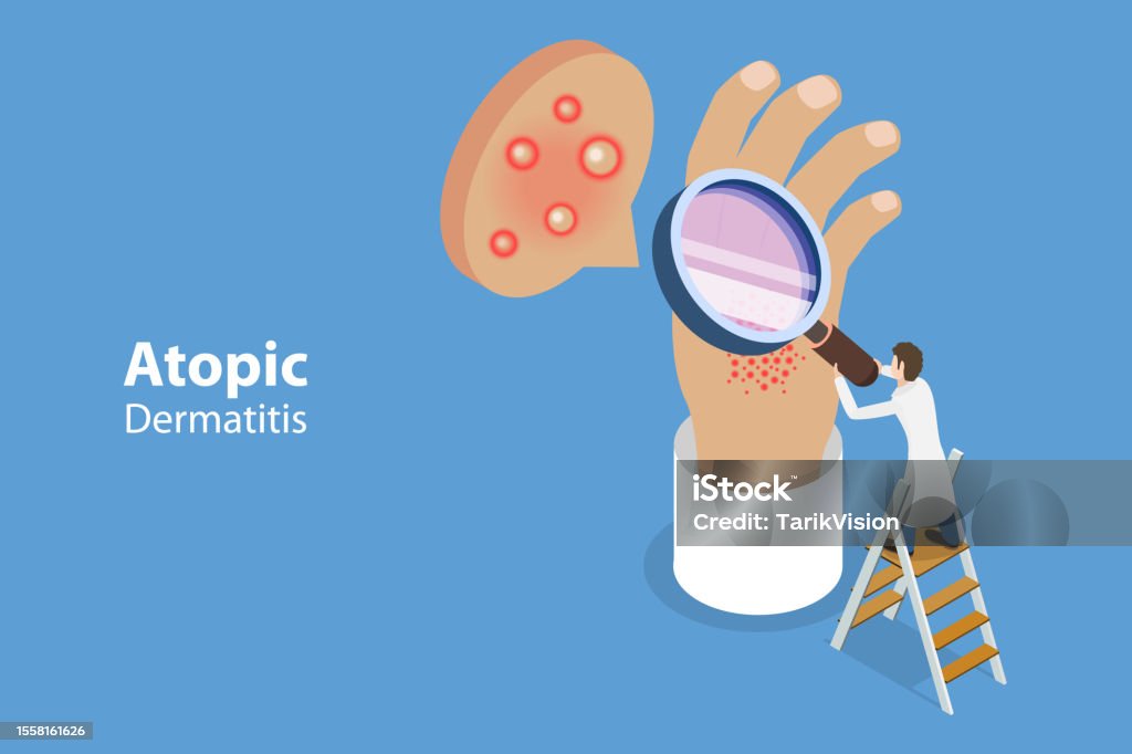 Detratitis Vector 3d Isometric Flat Vector Conceptual Illustration Of Atopic Dermatitis ...