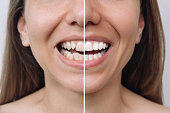 Young woman before and after veneers installation. Correction of uneven teeth with braces. Comparison