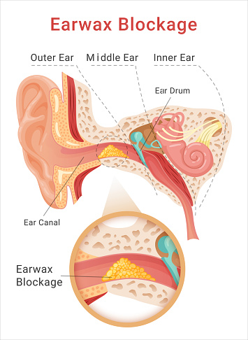 Earwax blockage medical science educational scheme cerumen impaction condition middle or inner ear vector flat illustration. Skin irritation tinnitus and hearing loss cause. Human anatomy education