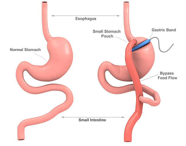 Band Gastric Bypass Surgery (3D) stock photo
