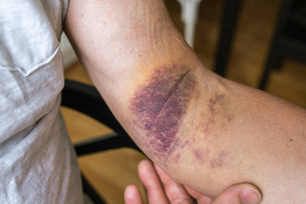injury ligament arm bruise