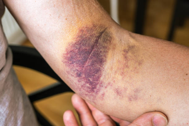 istock injury ligament arm bruise 1560825445