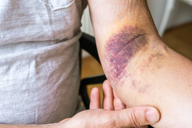 istock injury ligament arm bruise 1560826497