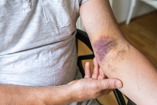 istock injury ligament arm bruise 1560827602