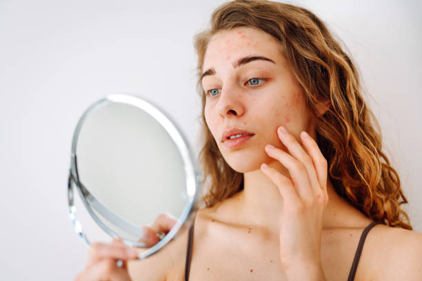 istock Skin problem. Curly woman touches red inflammations on her face while looking in the mirror in a bright room. 1561505149