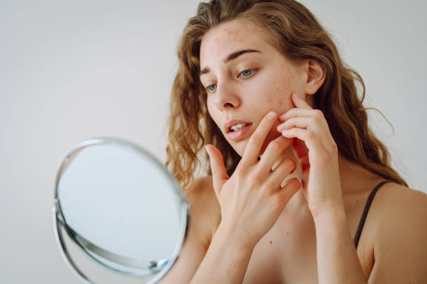 istock Skin problem. Curly woman touches red inflammations on her face while looking in the mirror in a bright room. 1561505150