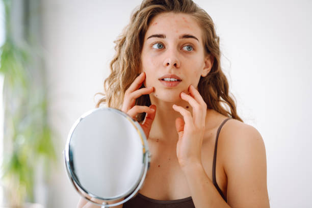 istock Skin problem. Curly woman touches red inflammations on her face while looking in the mirror in a bright room. 1561505170