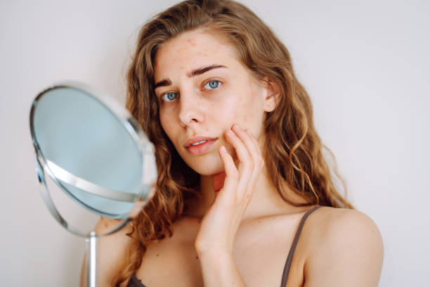 istock Skin problem. Curly woman touches red inflammations on her face while looking in the mirror in a bright room. 1561505681
