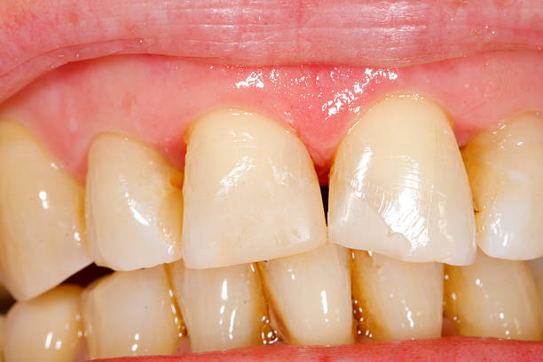 istock Composite filling tooth treatment 156300701