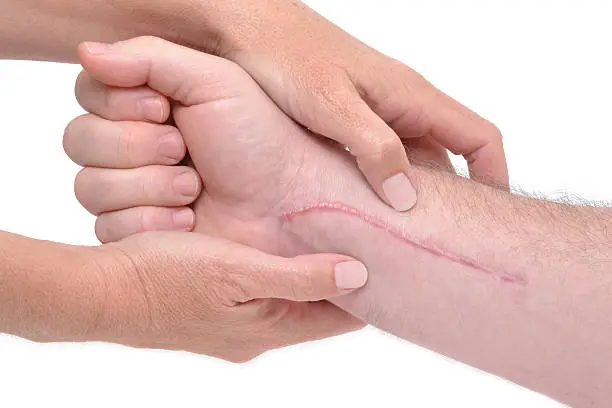 Photo of Close-up of arm massage around long scar near wrist