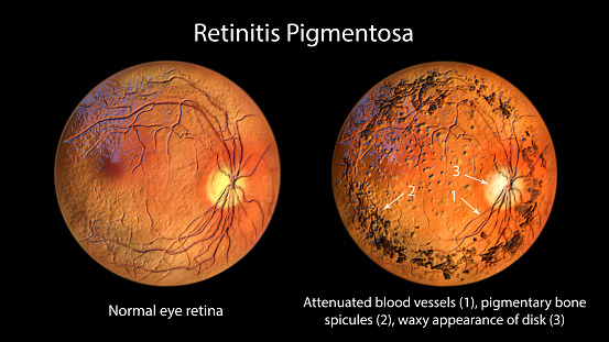 Retinitis pigmentosa, a genetic eye disease. 3D illustration shows normal eye retina and attenuated blood vessels, pigmentary bone spicules and waxy appearance of the optic disk in the affected retina