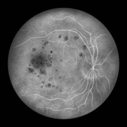 Autosomal recessive bestrophinopathy, scientific illustration showing accumulation of lipofuscin deposits around and beyond the macula leading to progressive retinal damage, fluorescein angiography