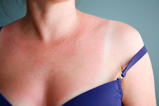 istock Woman with sunburned skin. Burn. 1565710458
