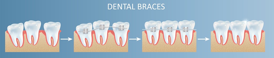 Braces Process Dental Teeth Braces Installation Steps Vector Poster Stock Illustration ...