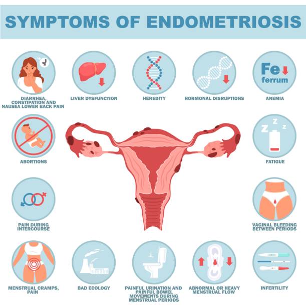gejala endometriosis ilustrasi vektor penyakit reproduksi - serviks foto ilustrasi stok
