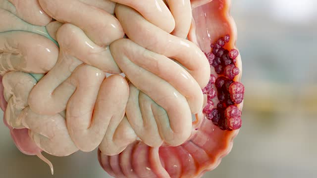 Bowel cancer or Colorectal tumor, Colon cancer,  intestine inflammatory bowel Disease,  intestine pain, celiac, infections, duplicating, cells expanding, malignant cancerous, viruses, 3d render