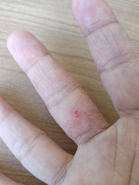 istock fingers affected by eczema or allergies. 1568772139